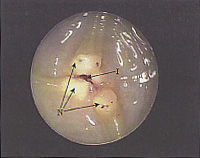 損傷による粘膜の剥がれと炎症