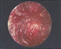 綿製またはプラスチック製乳管挿入後の炎症